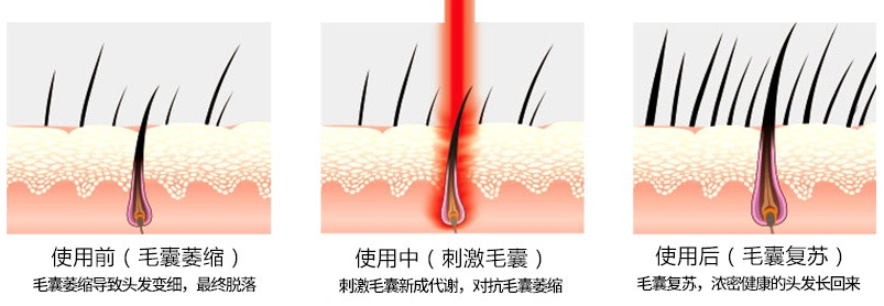 激光生发仪赠送新一代生发养发组合厂家