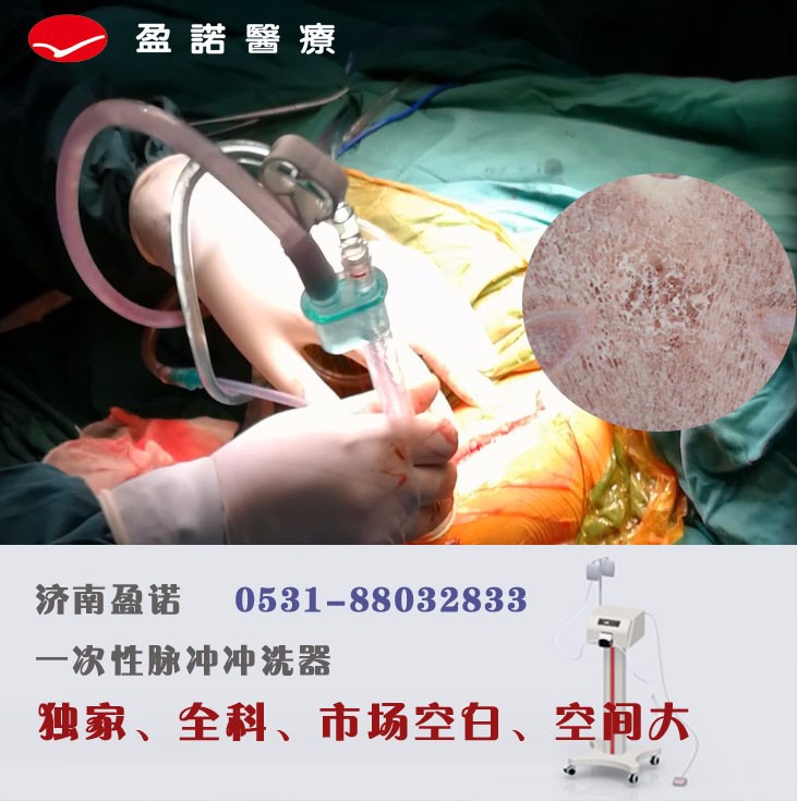 骨科耗材一次性脉冲冲洗器