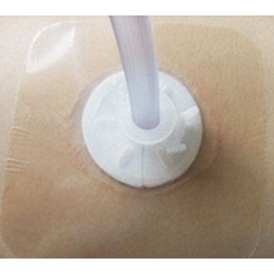 体表导管固定装置_简介