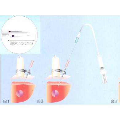 日本八光经皮酒精注射疗法针_简介