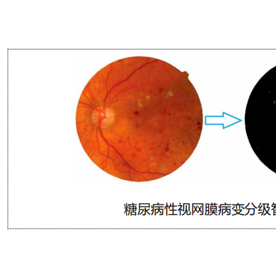 泰瑞眼科糖网AI分级诊断系统_简介