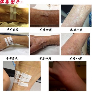 医用缝合拉扣_简介