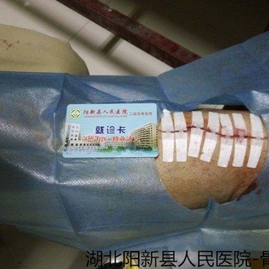 医用缝合拉扣_简介