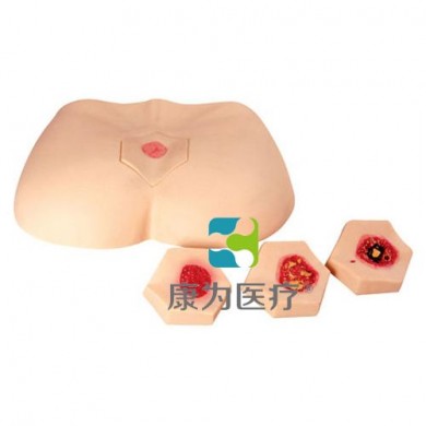 阶段褥疮护理模型_简介