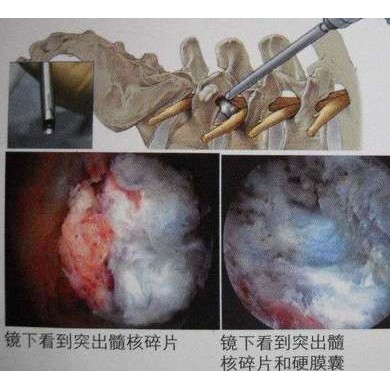 椎间孔镜_简介