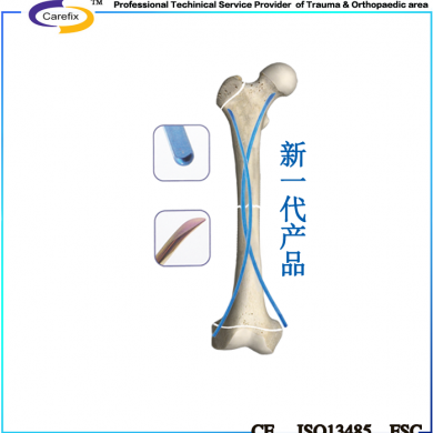 上海开为Carefix第二代弹性髓内针锁骨骨折_简介